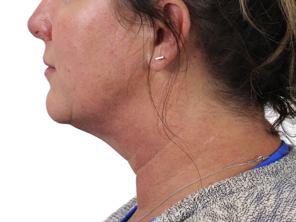 Deep Neck Lift Before & After Gallery - Patient 147538134 - Image 9