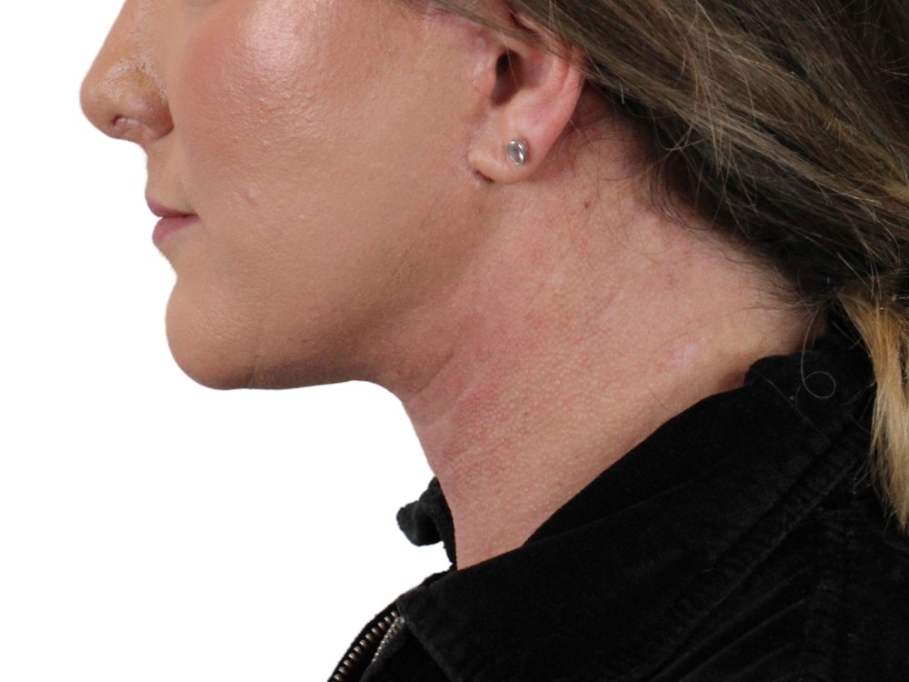 Deep Neck Lift Before & After Gallery - Patient 147538134 - Image 10