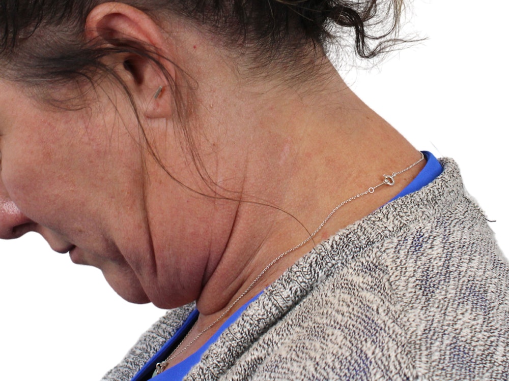 Deep Neck Lift Before & After Gallery - Patient 147538134 - Image 11