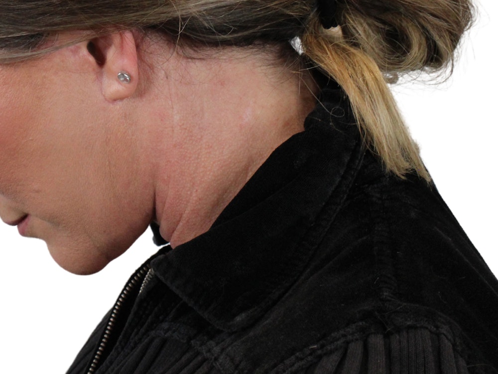 Deep Neck Lift Before & After Gallery - Patient 147538134 - Image 12