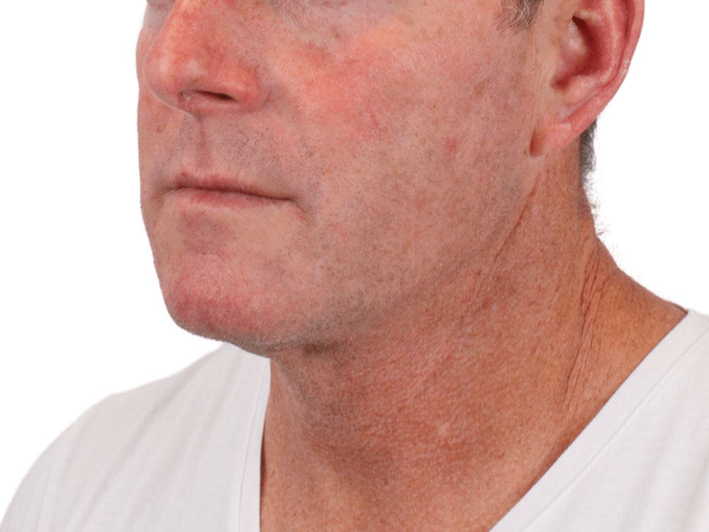 Deep Neck Lift Before & After Gallery - Patient 148352223 - Image 3