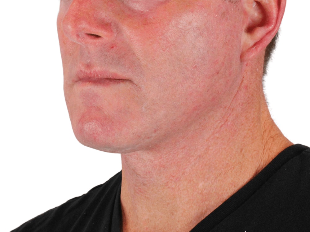 Deep Neck Lift Before & After Gallery - Patient 148352223 - Image 4
