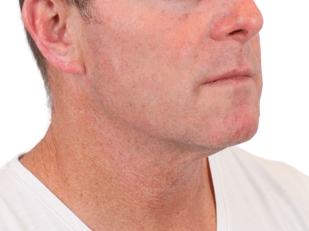 Deep Neck Lift Before & After Gallery - Patient 148352223 - Image 5