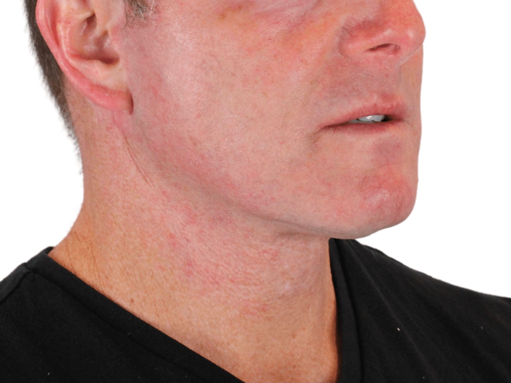 Deep Neck Lift Before & After Gallery - Patient 148352223 - Image 6