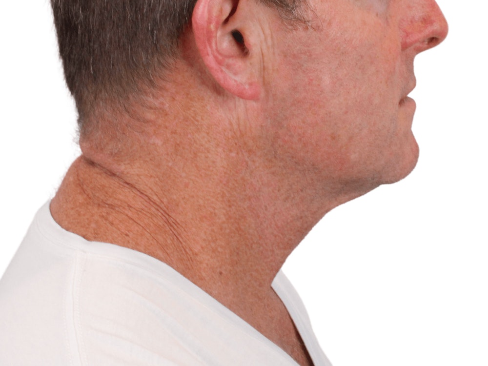 Deep Neck Lift Before & After Gallery - Patient 148352223 - Image 7