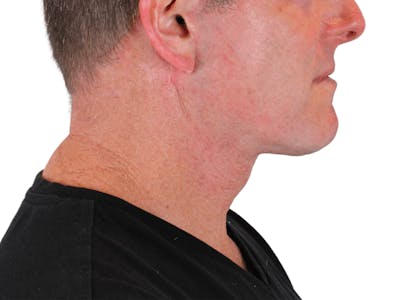 Deep Neck Lift Before & After Gallery - Patient 148352223 - Image 8