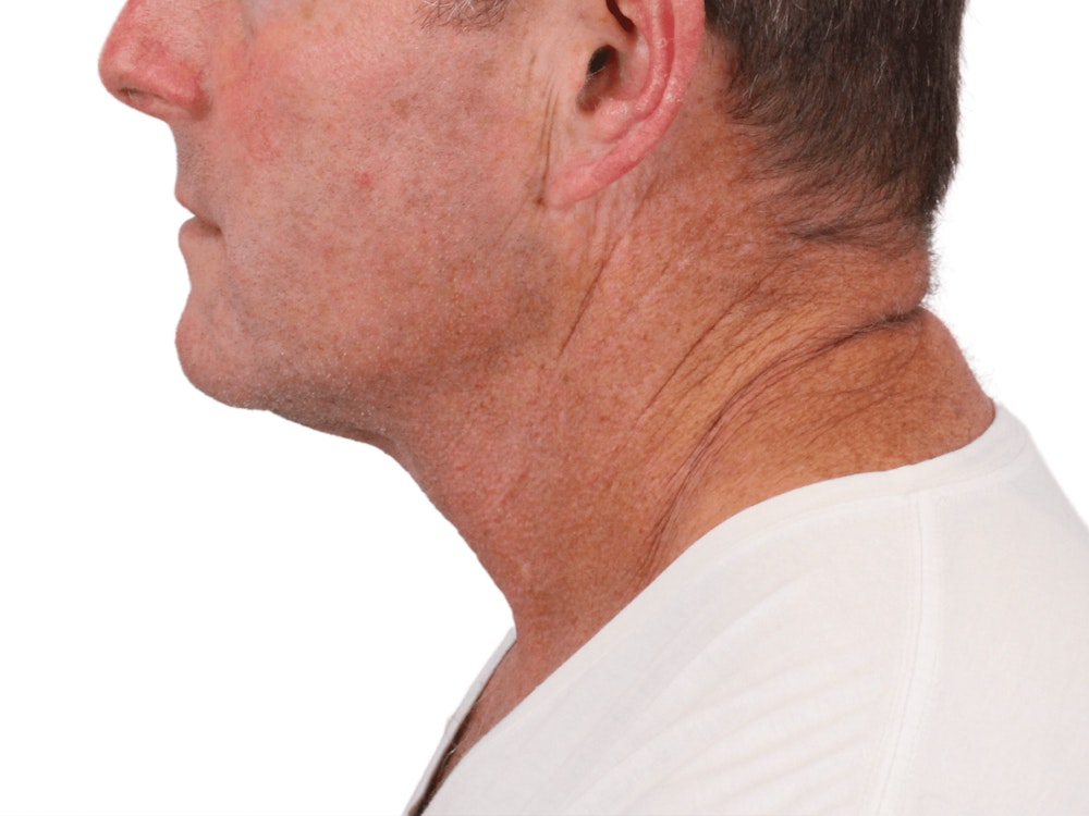 Deep Neck Lift Before & After Gallery - Patient 148352223 - Image 9