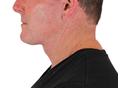 Deep Neck Lift Before & After Gallery - Patient 148352223 - Image 10