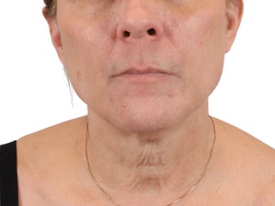 Deep Neck Lift Before & After Gallery - Patient 148352222 - Image 1