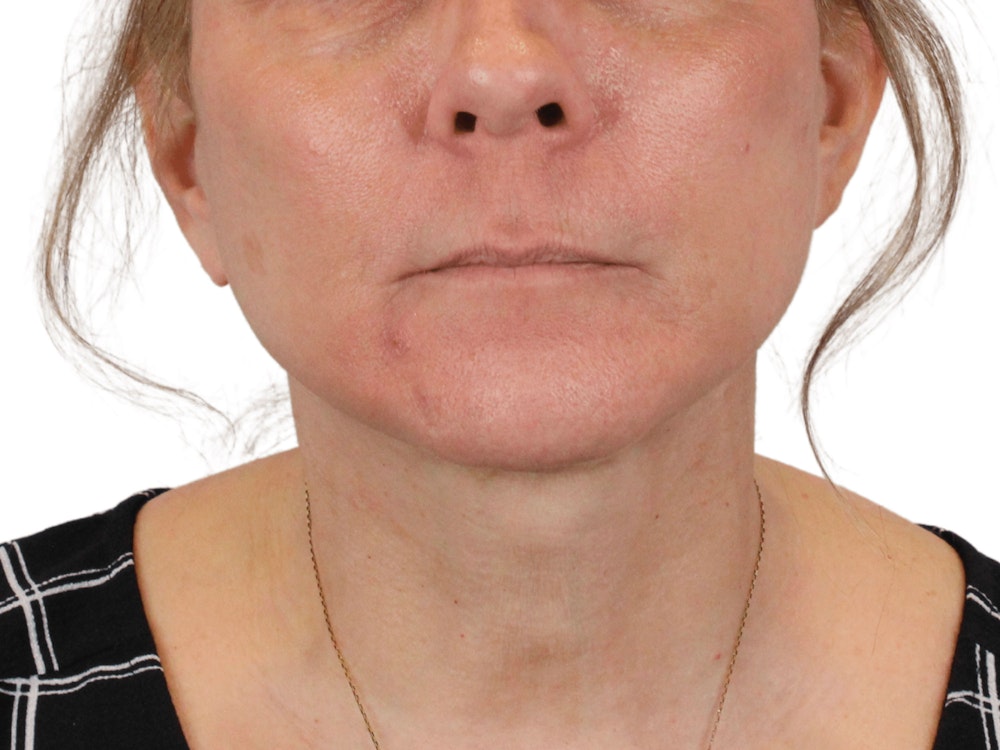Deep Neck Lift Before & After Gallery - Patient 148352222 - Image 2