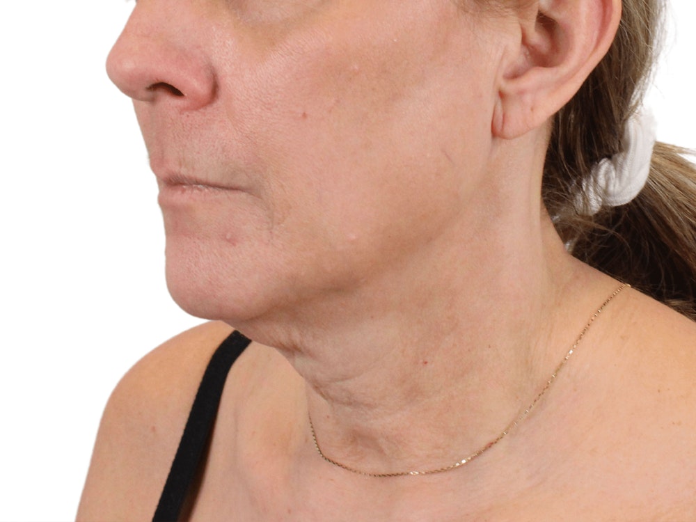 Deep Neck Lift Before & After Gallery - Patient 148352222 - Image 3