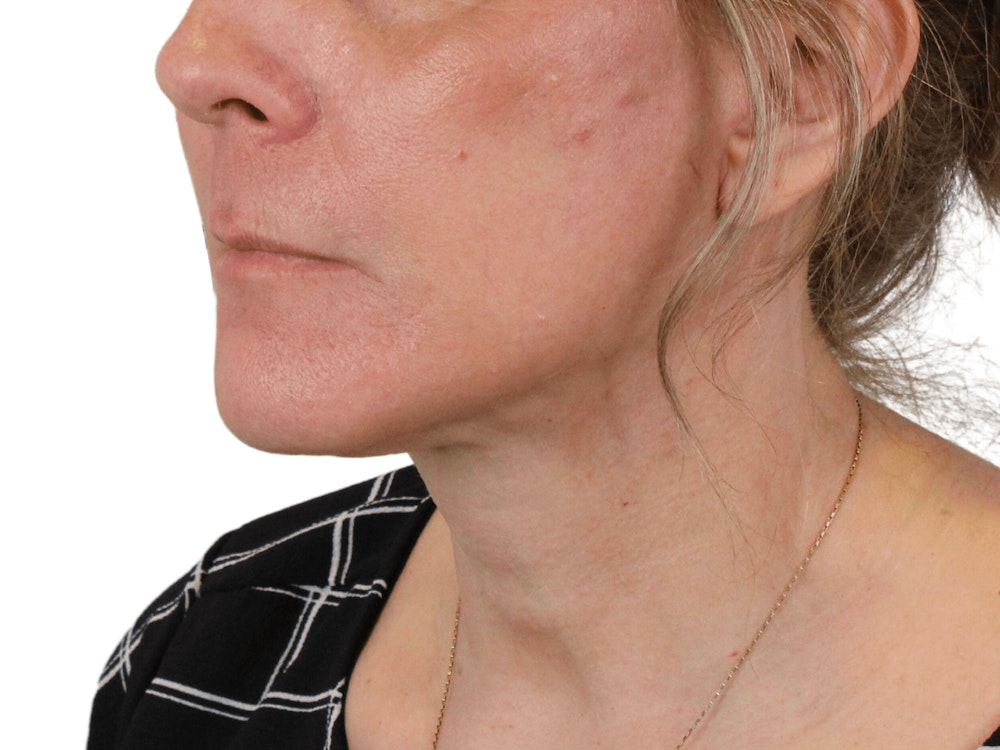 Deep Neck Lift Before & After Gallery - Patient 148352222 - Image 4