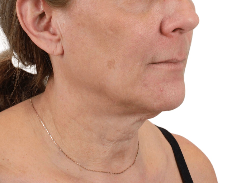 Deep Neck Lift Before & After Gallery - Patient 148352222 - Image 5