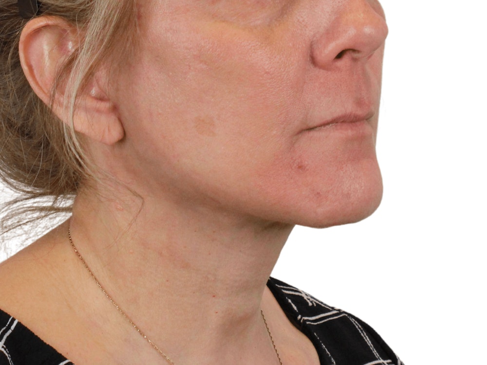 Deep Neck Lift Before & After Gallery - Patient 148352222 - Image 6