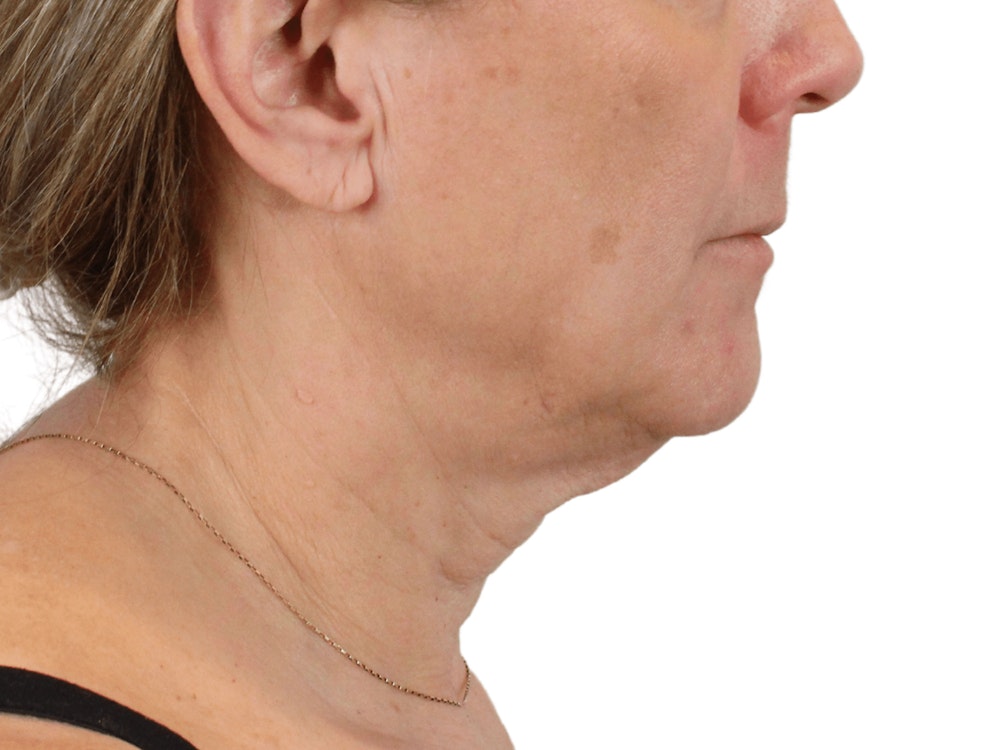 Deep Neck Lift Before & After Gallery - Patient 148352222 - Image 7