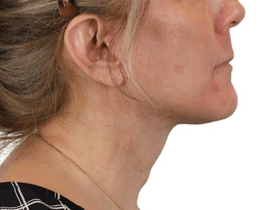 Deep Neck Lift Before & After Gallery - Patient 148352222 - Image 8