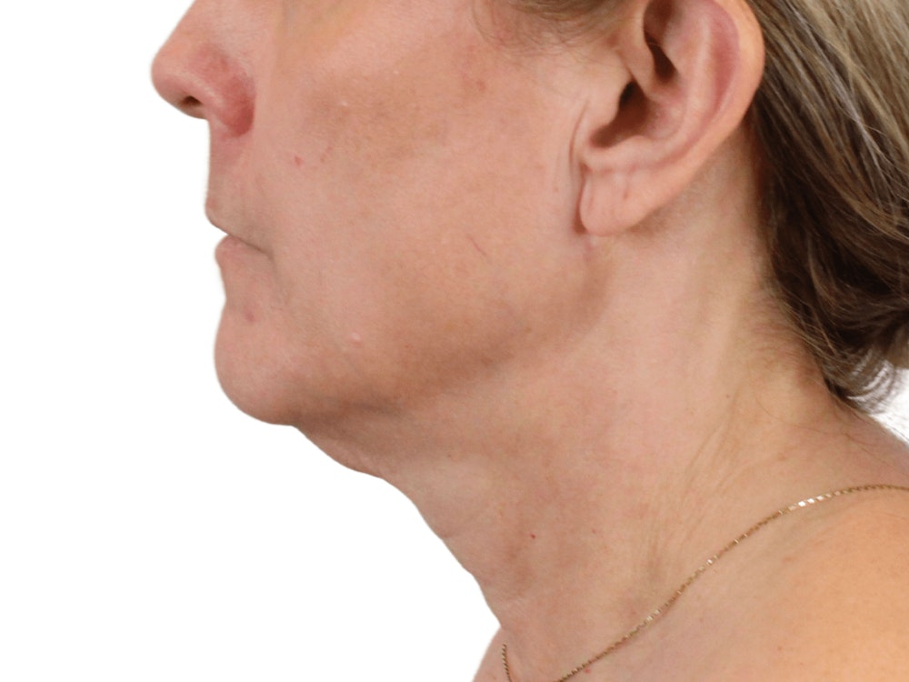 Deep Neck Lift Before & After Gallery - Patient 148352222 - Image 9