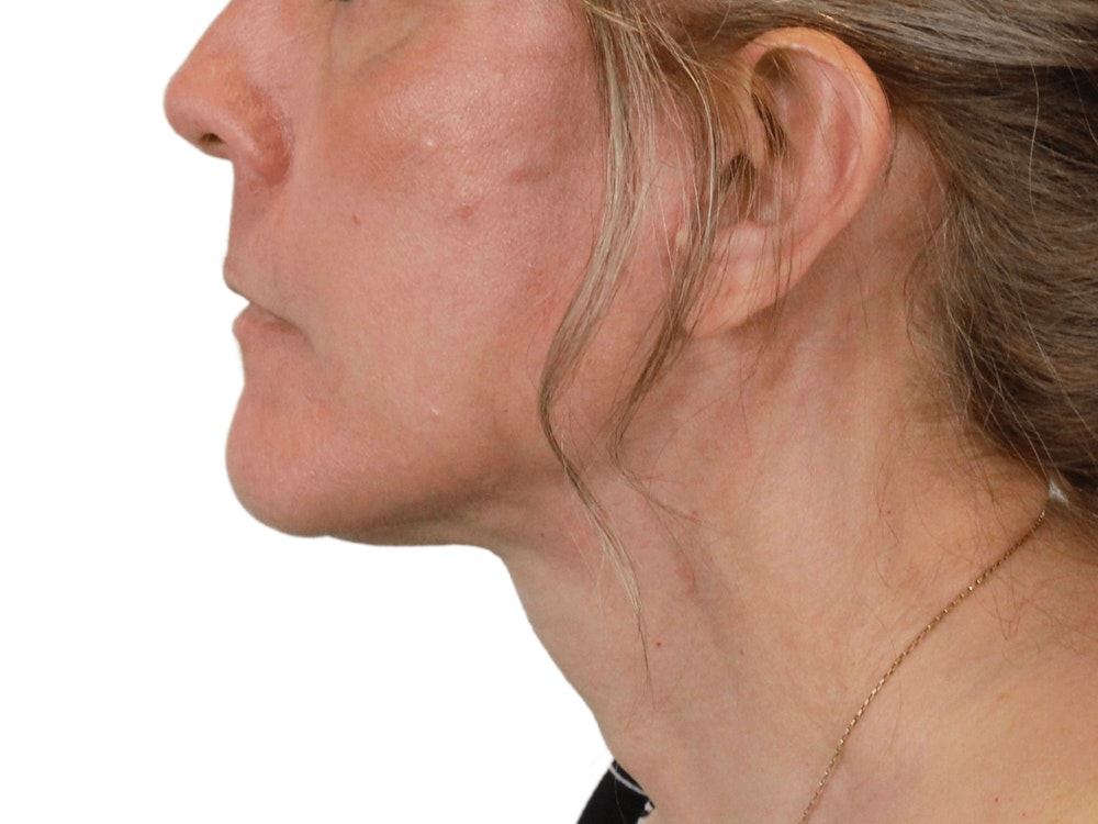 Deep Neck Lift Before & After Gallery - Patient 148352222 - Image 10