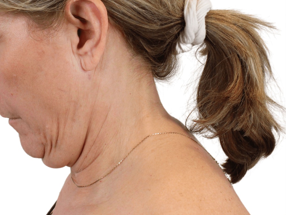 Deep Neck Lift Before & After Gallery - Patient 148352222 - Image 11