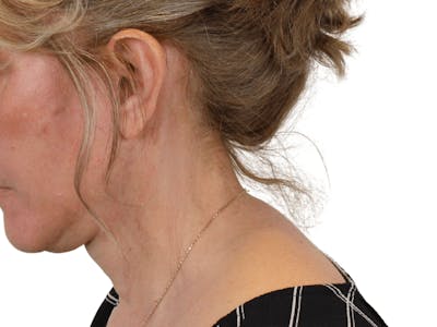 Deep Neck Lift Before & After Gallery - Patient 148352222 - Image 12