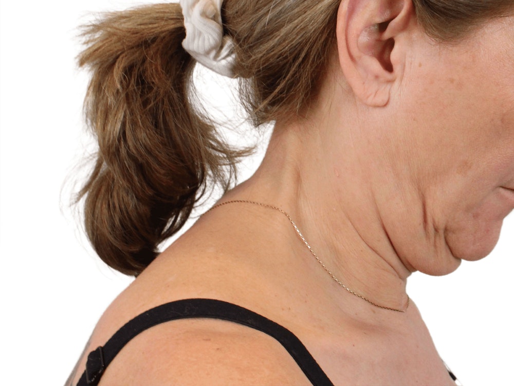Deep Neck Lift Before & After Gallery - Patient 148352222 - Image 13