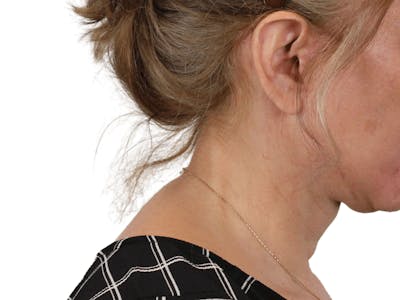 Deep Neck Lift Before & After Gallery - Patient 148352222 - Image 14