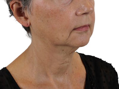 Deep Neck Lift Before & After Gallery - Patient 142006982 - Image 1