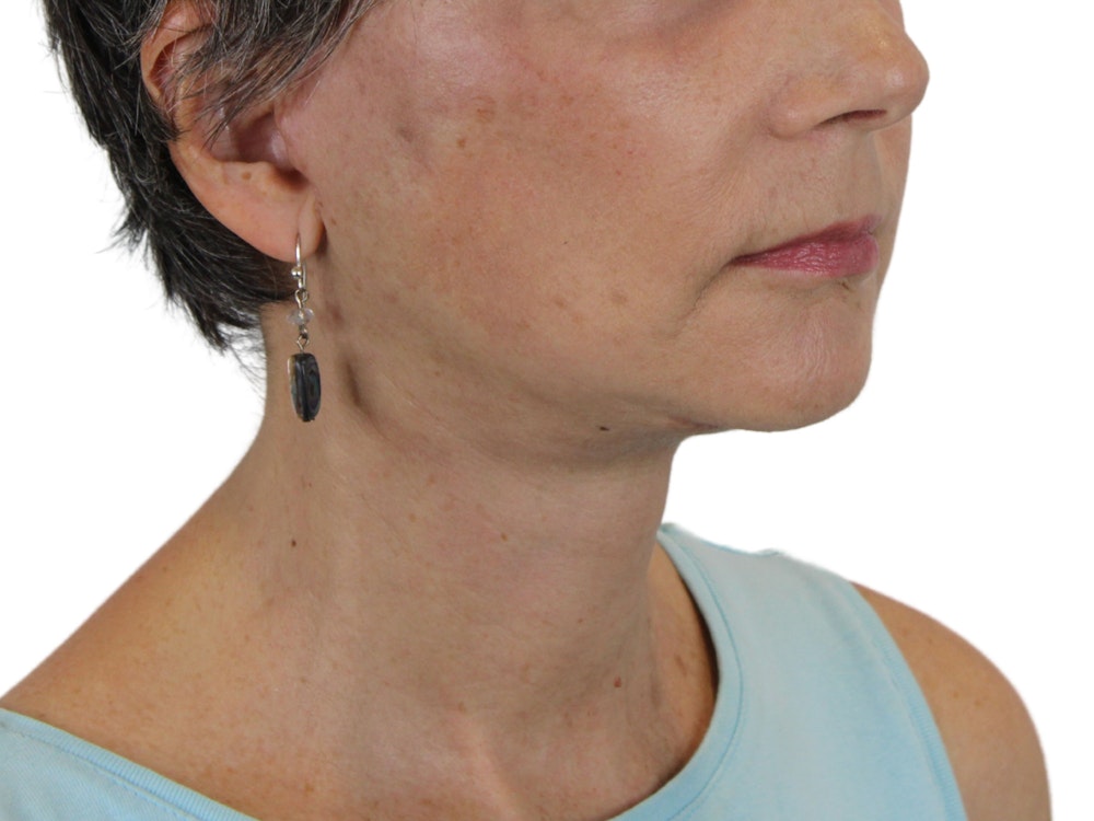 Deep Neck Lift Before & After Gallery - Patient 142006982 - Image 2