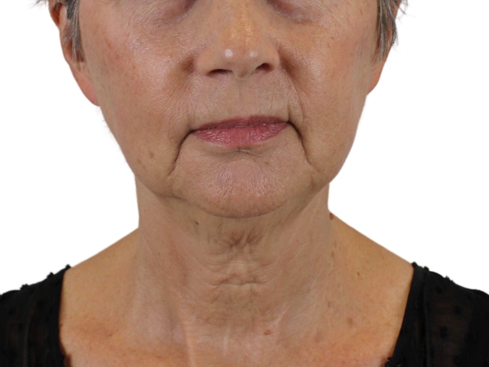 Deep Neck Lift Before & After Gallery - Patient 142006982 - Image 3