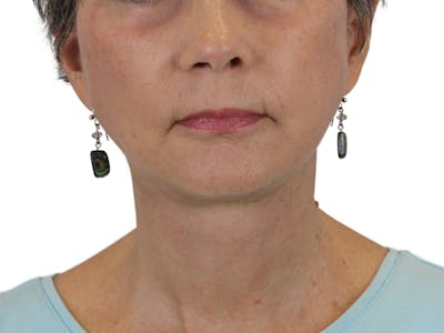Deep Neck Lift Before & After Gallery - Patient 142006982 - Image 4