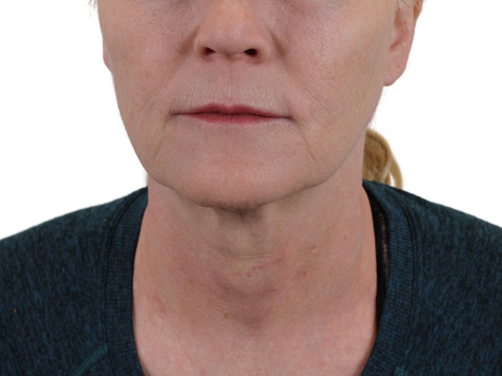 Deep Neck Lift Before & After Gallery - Patient 131840909 - Image 1