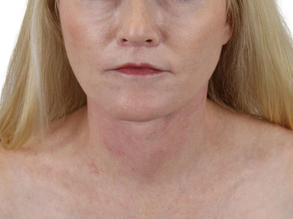 Deep Neck Lift Before & After Gallery - Patient 131840909 - Image 2