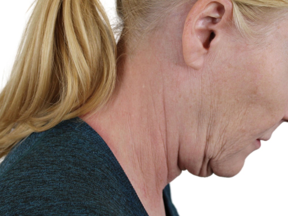 Deep Neck Lift Before & After Gallery - Patient 131840909 - Image 3