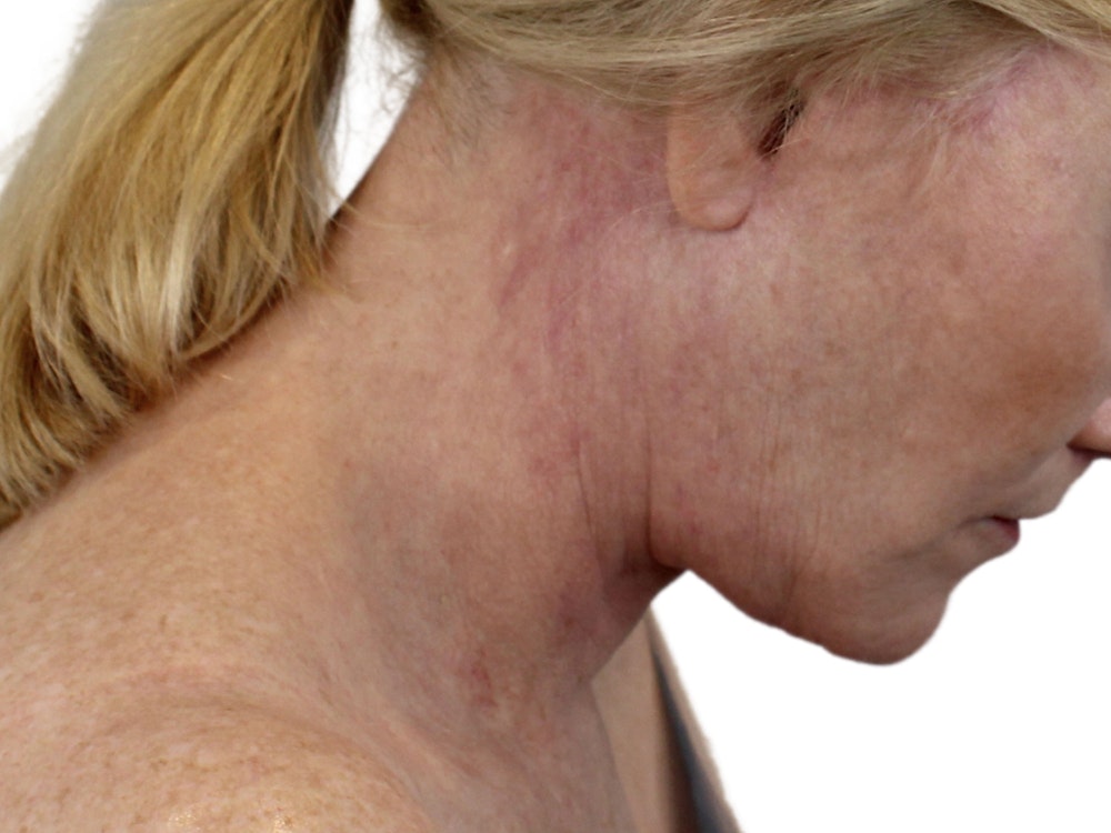 Deep Neck Lift Before & After Gallery - Patient 131840909 - Image 4