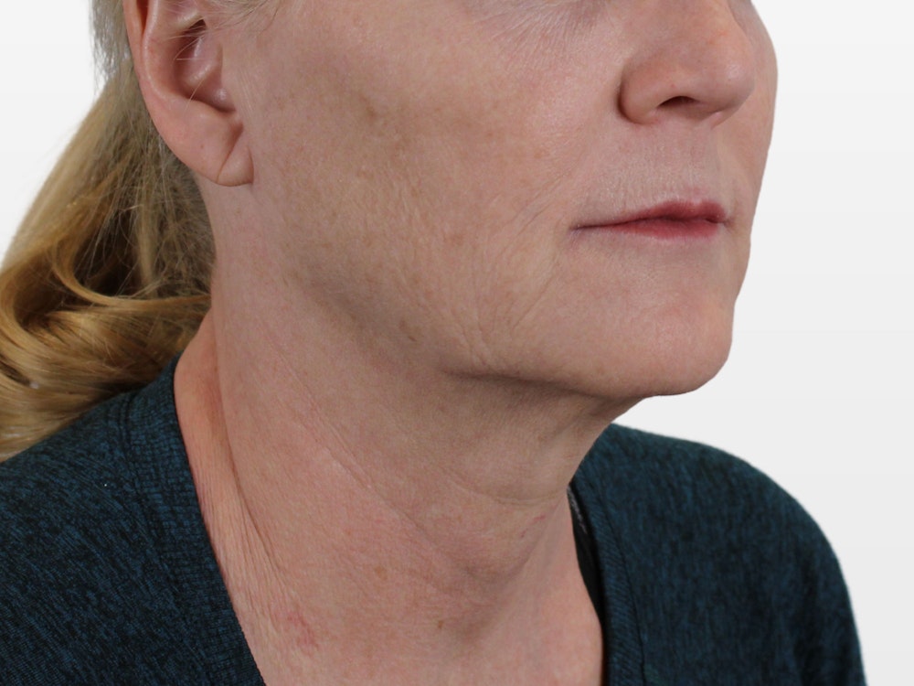 Deep Neck Lift Before & After Gallery - Patient 131840909 - Image 5