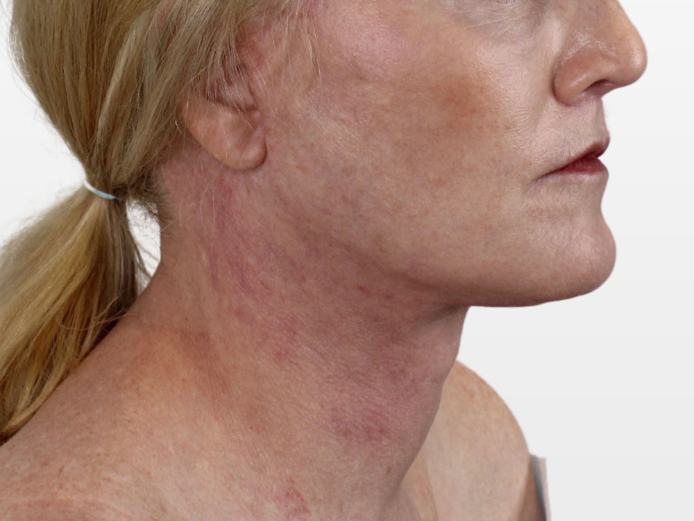 Deep Neck Lift Before & After Gallery - Patient 131840909 - Image 6