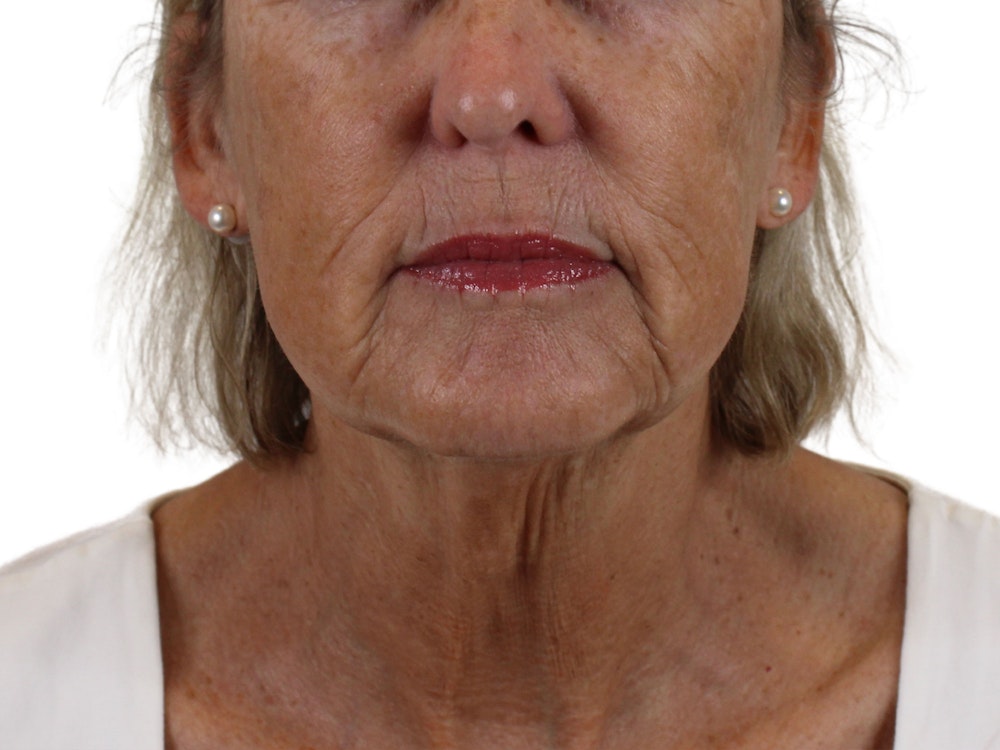 Deep Neck Lift Before & After Gallery - Patient 143555065 - Image 1