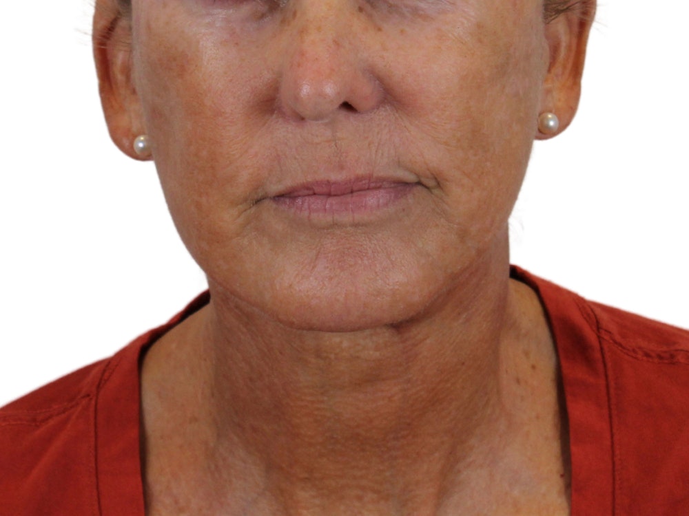 Deep Neck Lift Before & After Gallery - Patient 143555065 - Image 2