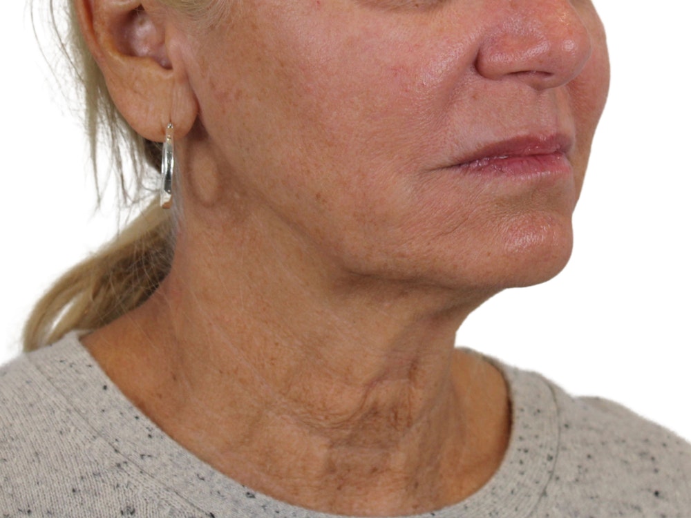 Deep Neck Lift Before & After Gallery - Patient 121595731 - Image 1
