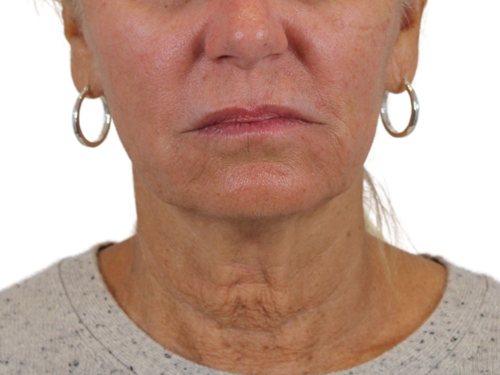 Deep Neck Lift Before & After Gallery - Patient 121595731 - Image 3