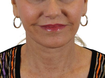 Deep Neck Lift Before & After Gallery - Patient 121595731 - Image 4