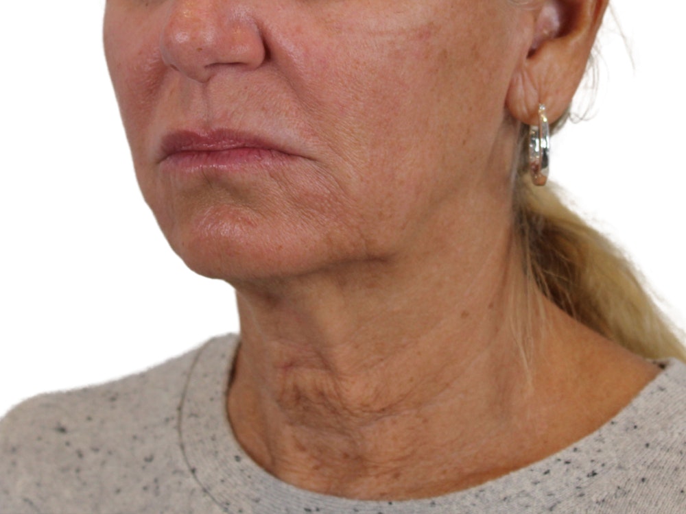 Deep Neck Lift Before & After Gallery - Patient 121595731 - Image 5