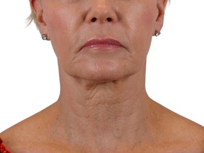 Deep Neck Lift Before & After Gallery - Patient 120947130 - Image 1