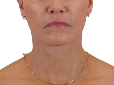 Deep Neck Lift Before & After Gallery - Patient 120947130 - Image 2