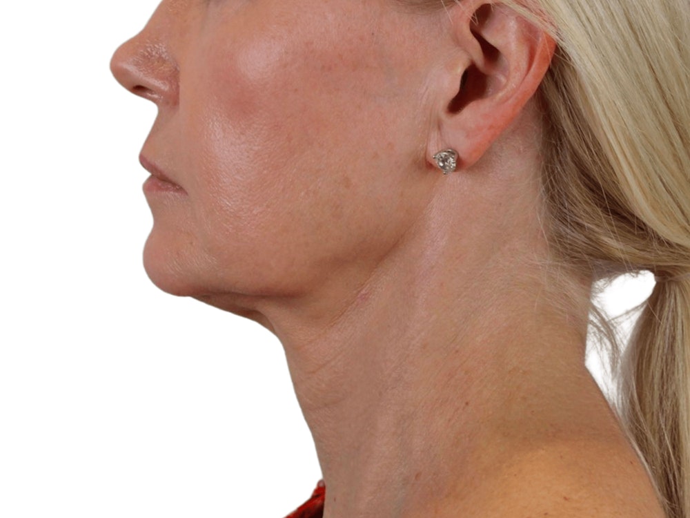 Deep Neck Lift Before & After Gallery - Patient 120947130 - Image 3