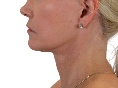 Deep Neck Lift Before & After Gallery - Patient 120947130 - Image 4