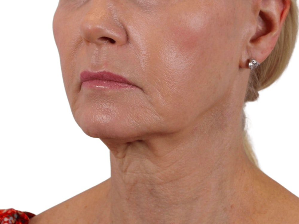 Deep Neck Lift Before & After Gallery - Patient 120947130 - Image 5