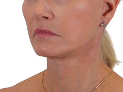 Deep Neck Lift Before & After Gallery - Patient 120947130 - Image 6