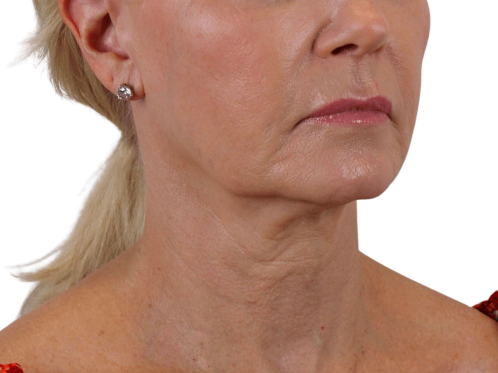 Deep Neck Lift Before & After Gallery - Patient 120947130 - Image 7