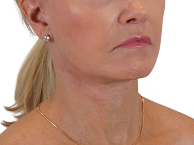 Deep Neck Lift Before & After Gallery - Patient 120947130 - Image 8